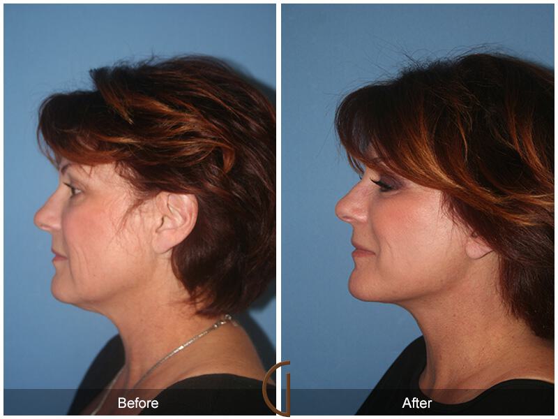 Facelift Fifties Before & After Photo