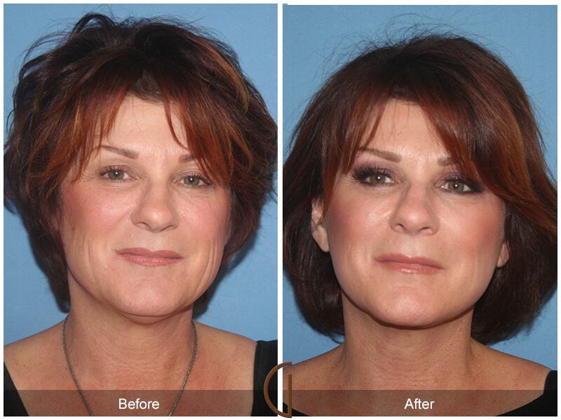 Facelift Fifties Before & After Photo