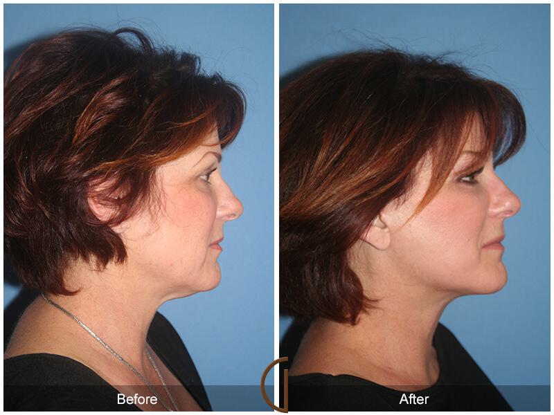 Facelift Fifties Before & After Photo