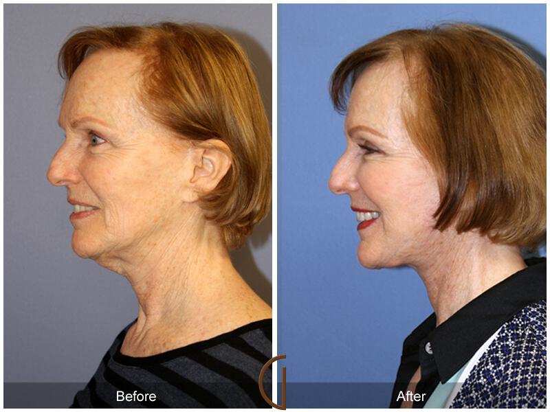 Facelift Fifties Before & After Photo