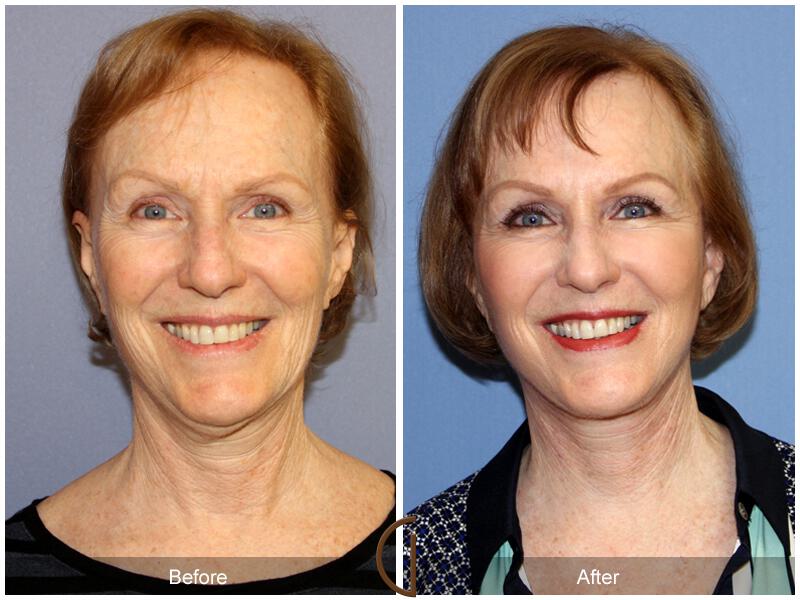 Facelift Fifties Before & After Photo