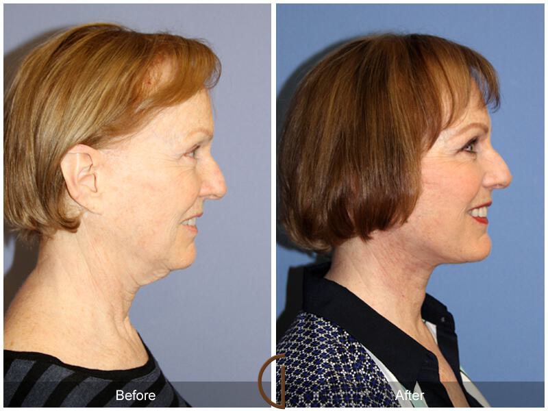 Facelift Fifties Before & After Photo