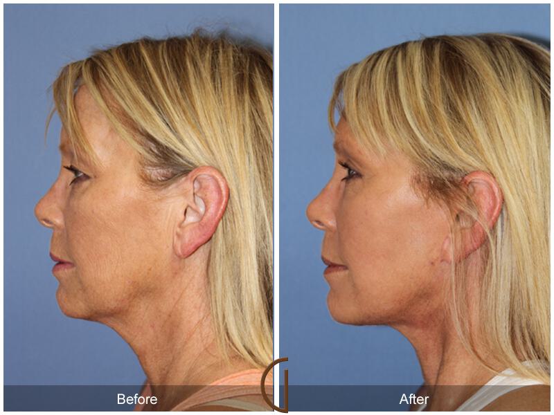 Facelift Fifties Before & After Photo