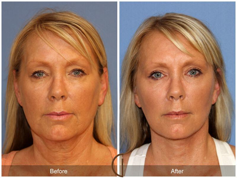 Facelift Fifties Before & After Photo