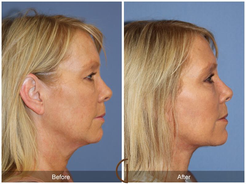 Facelift Fifties Before & After Photo