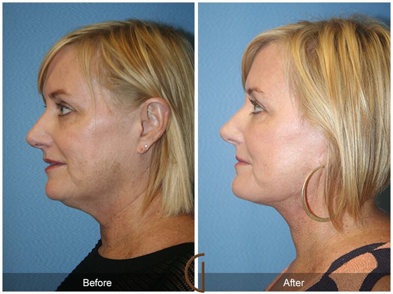 Facelift Fifties Before & After Photo