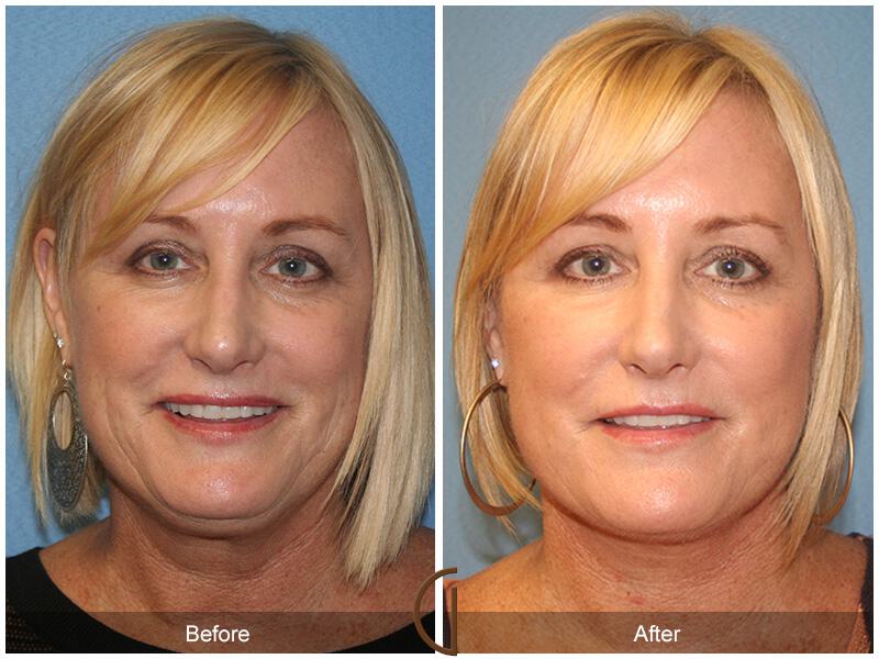 Facelift Fifties Before & After Photo