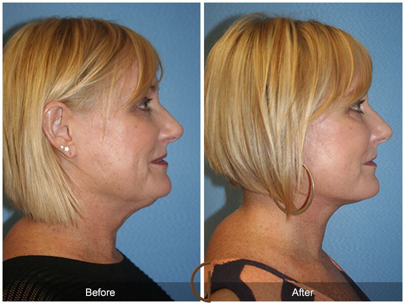 Facelift Fifties Before & After Photo