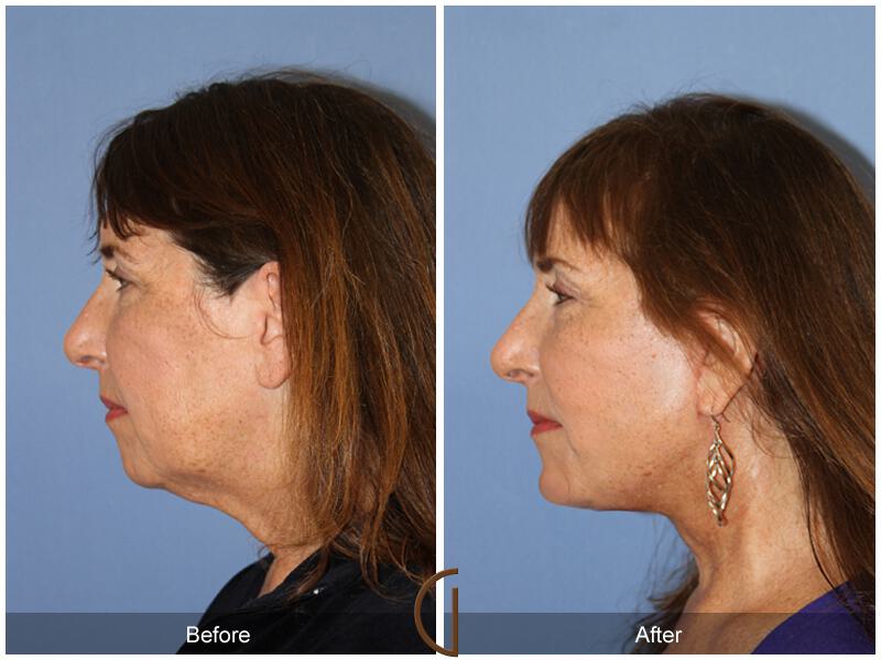 Facelift Fifties Before & After Photo