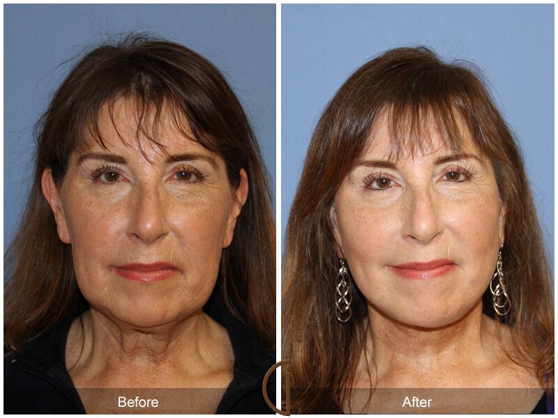 Facelift Fifties Before & After Photo