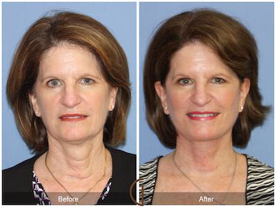 Facelift Fifties Before & After Photo