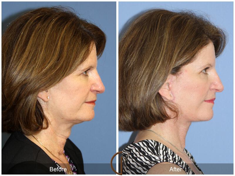 Facelift Fifties Before & After Photo