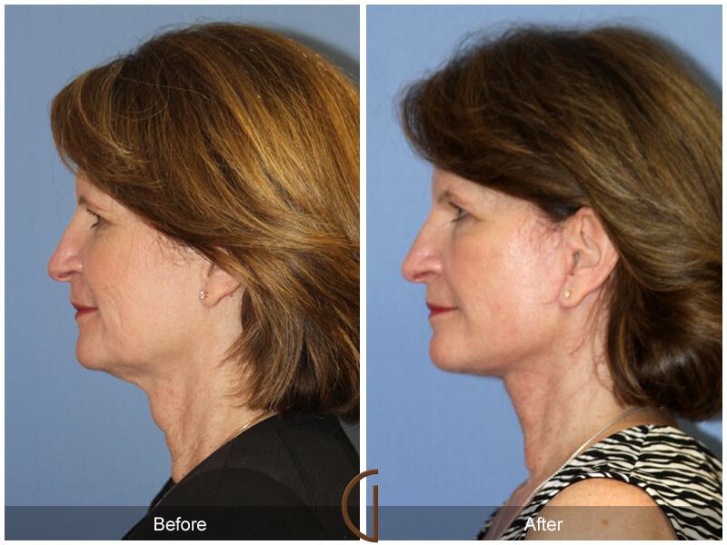 Facelift Fifties Before & After Photo