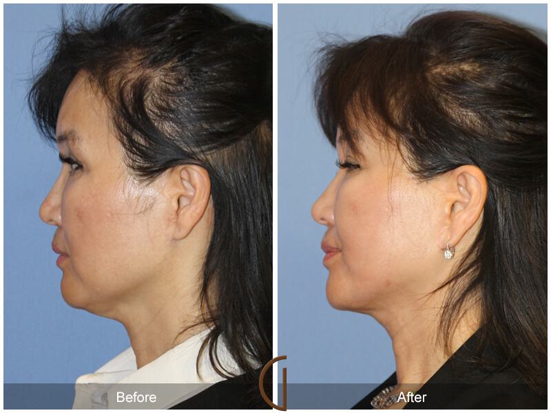 Facelift Fifties Before & After Photo