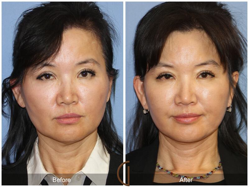 Facelift Fifties Before & After Photo