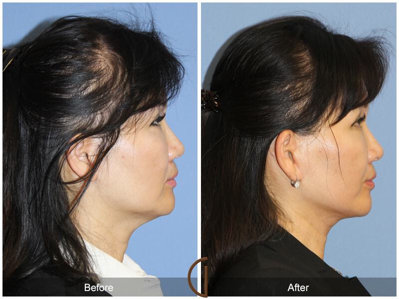 Facelift Fifties Before & After Photo