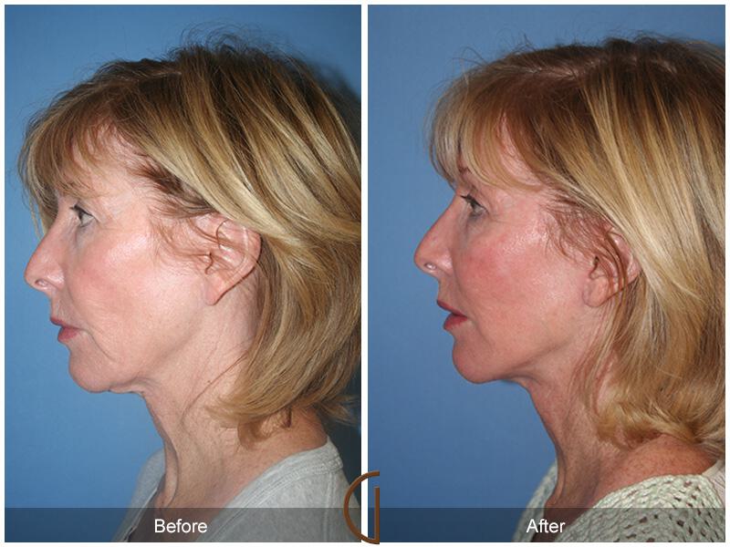 Facelift Fifties Before & After Photo