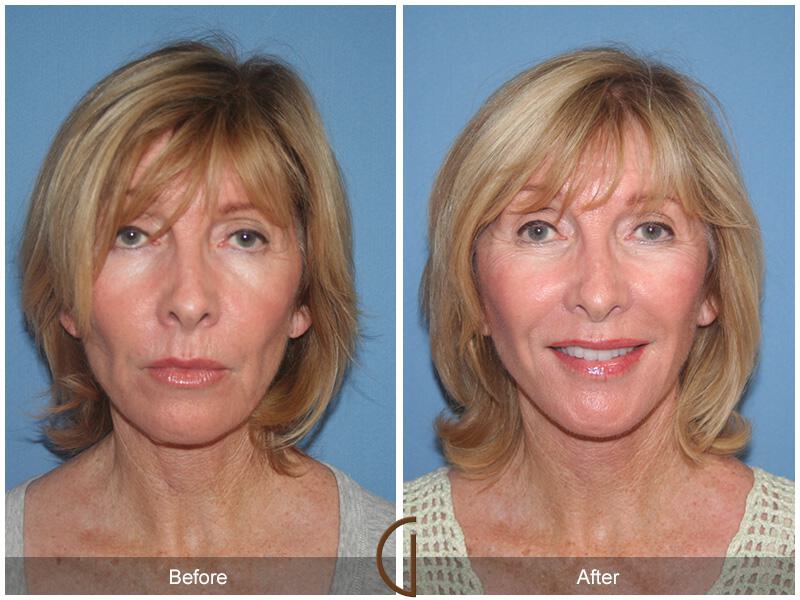 Facelift Fifties Before & After Photo