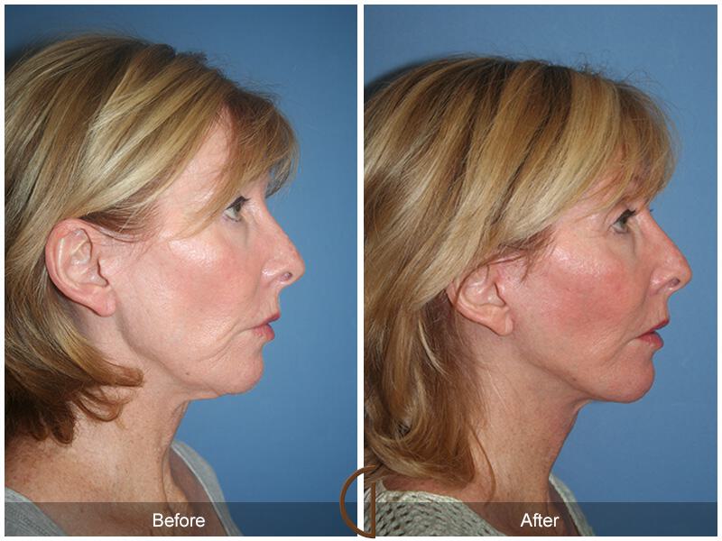 Facelift Fifties Before & After Photo