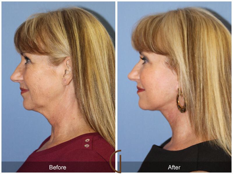 Facelift Fifties Before & After Photo