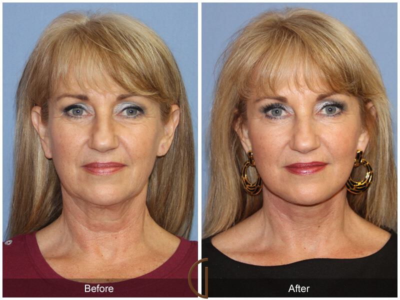 Facelift Fifties Before & After Photo