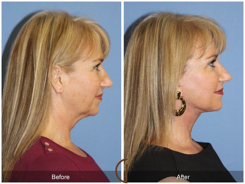 Facelift Fifties Before & After Photo