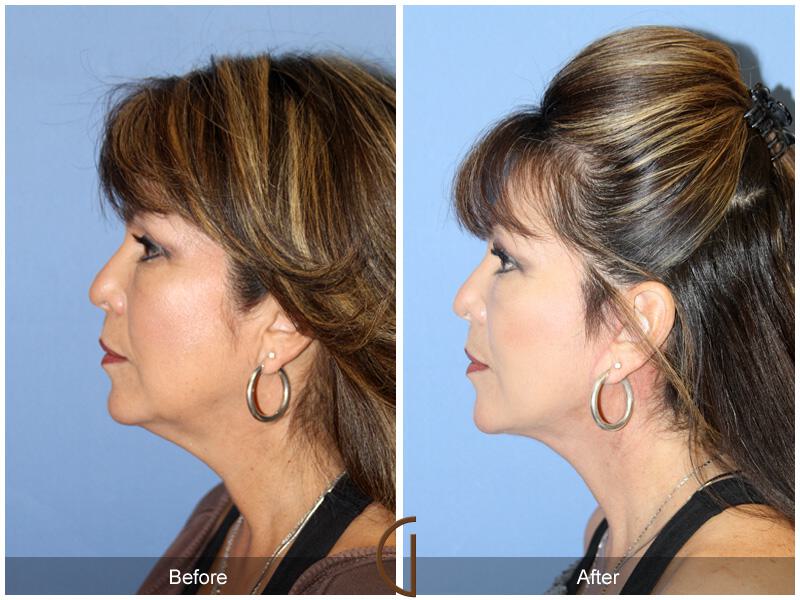 Facelift Fifties Before & After Photo