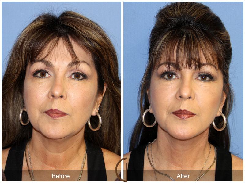 Facelift Fifties Before & After Photo