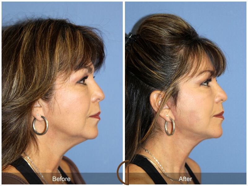 Facelift Fifties Before & After Photo