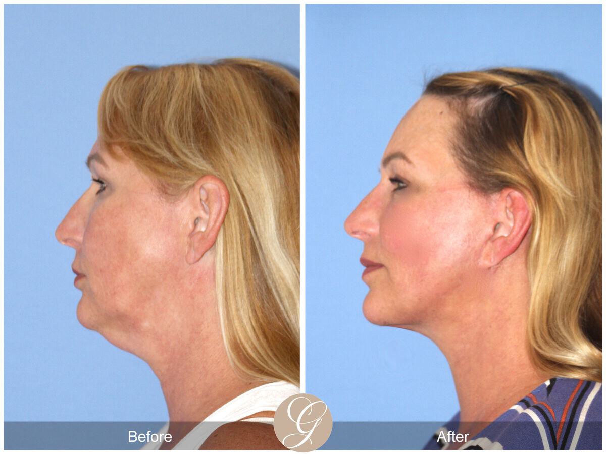 Facelift Fifties Before & After Photo