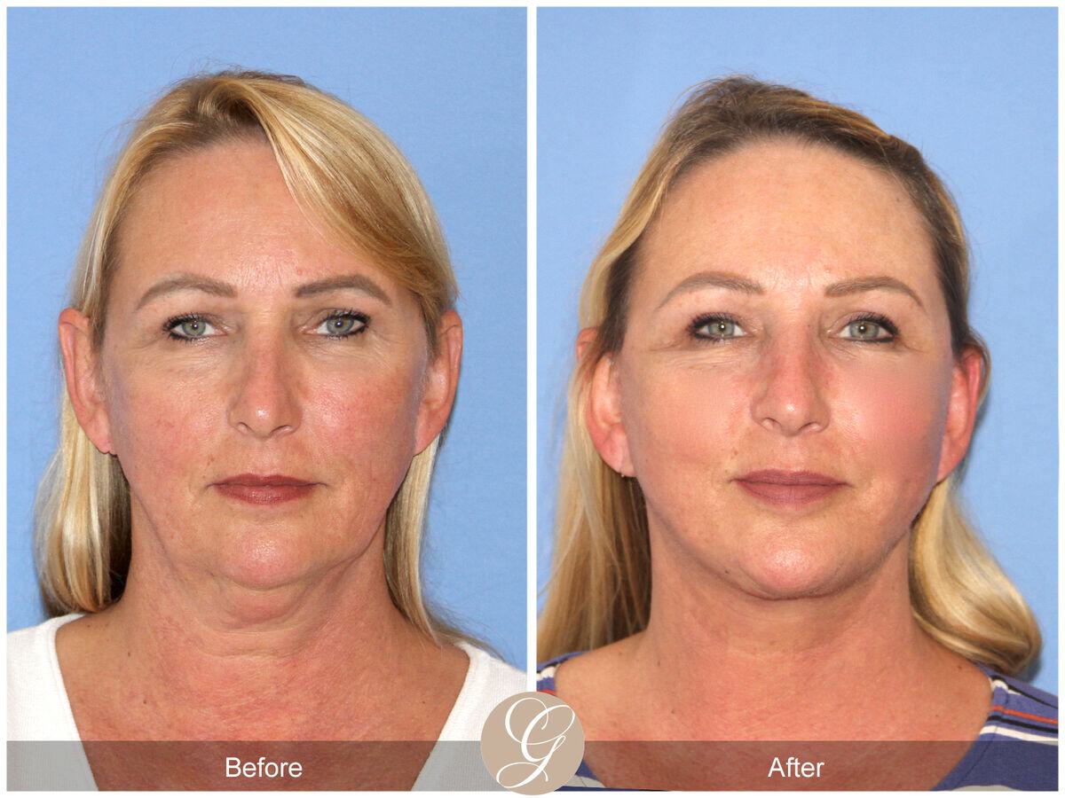 Facelift Fifties Before & After Photo