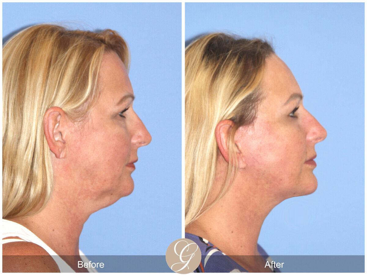 Facelift Fifties Before & After Photo