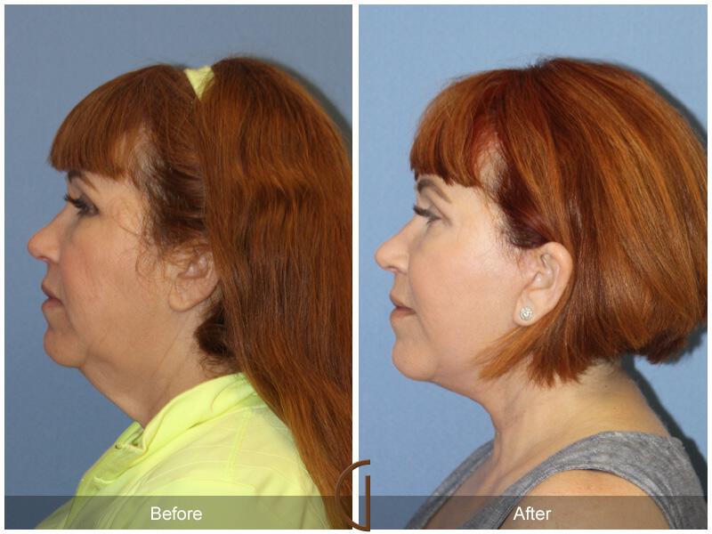 Facelift Fifties Before & After Photo