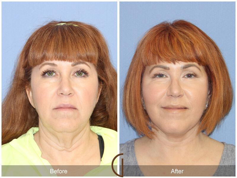 Facelift Fifties Before & After Photo