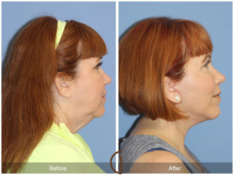 Facelift Fifties Before & After Photo