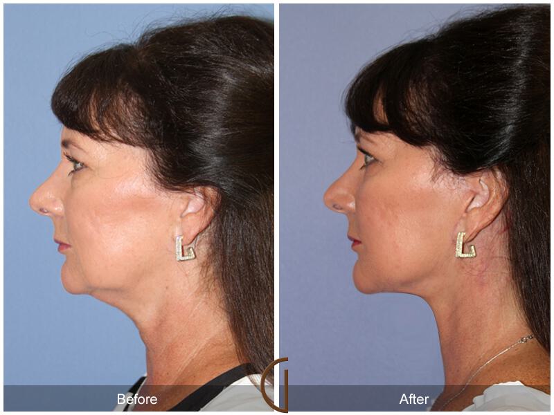 Facelift Fifties Before & After Photo