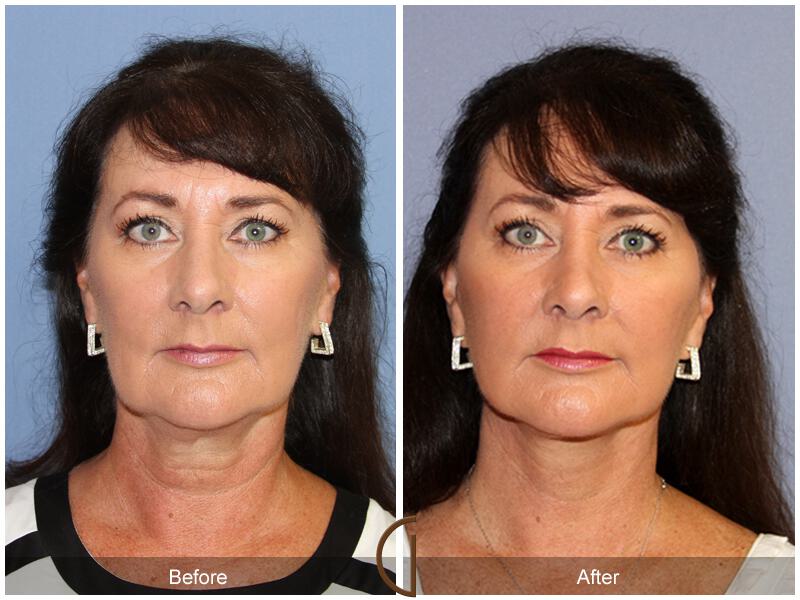 Facelift Fifties Before & After Photo