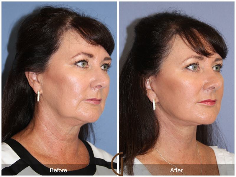 Facelift Fifties Before & After Photo