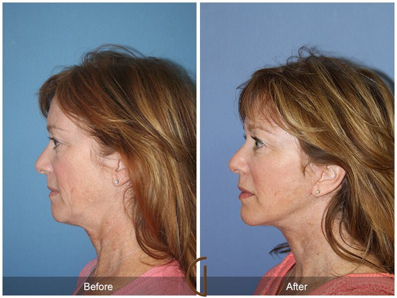 Facelift Fifties Before & After Photo