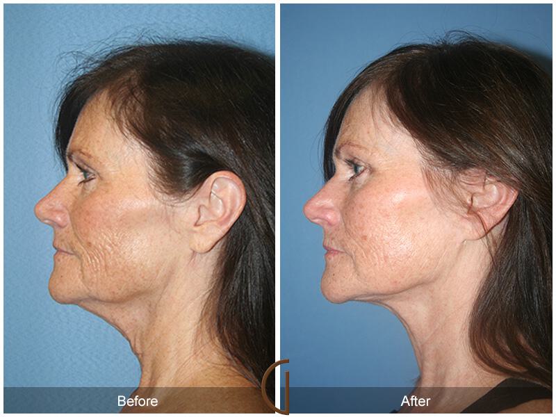 Facelift Fifties Before & After Photo