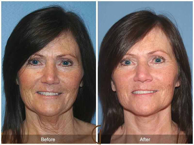 Facelift Fifties Before & After Photo