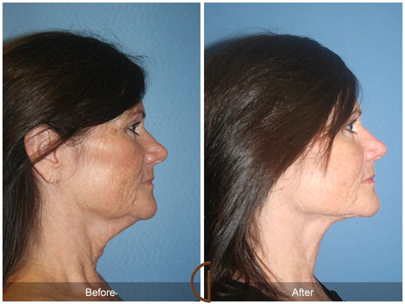 Facelift Fifties Before & After Photo