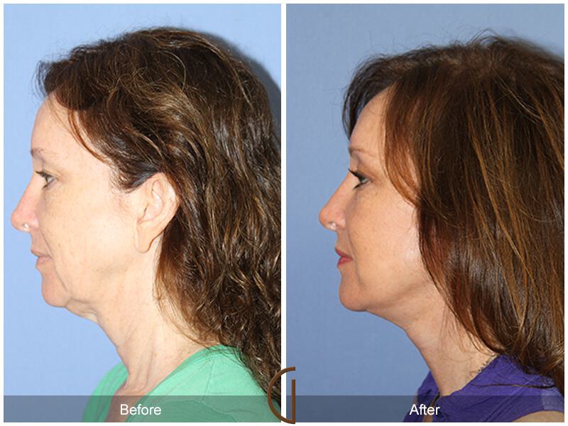 Facelift Fifties Before & After Photo