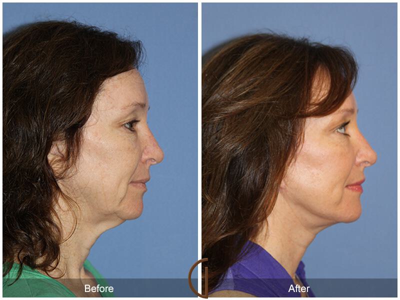 Facelift Fifties Before & After Photo