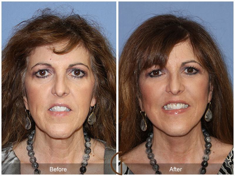 Facelift Fifties Before & After Photo