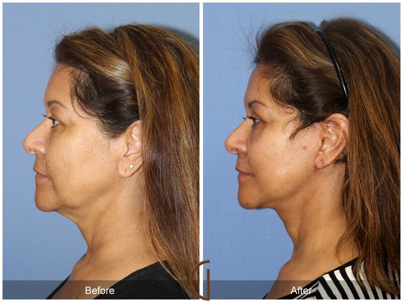 Facelift Fifties Before & After Photo