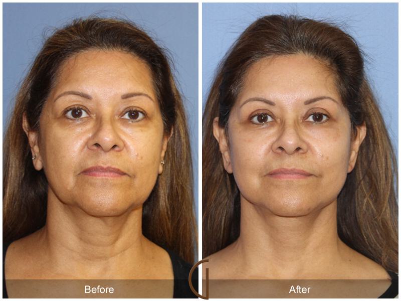 Facelift Fifties Before & After Photo