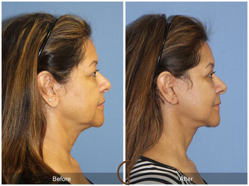Facelift Fifties Before & After Photo