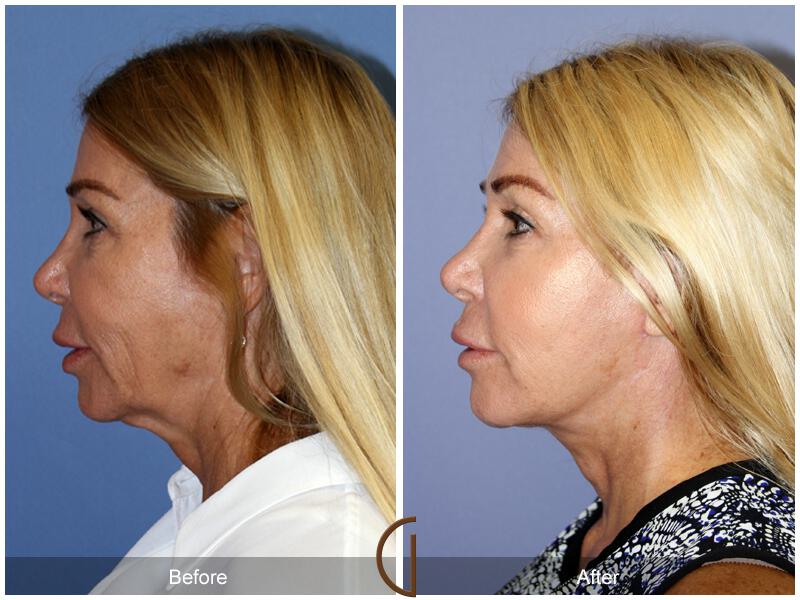 Facelift Fifties Before & After Photo