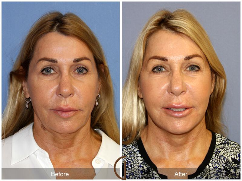 Facelift Fifties Before & After Photo